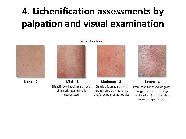 4. Lichenification assessments by palpation and visual examination 