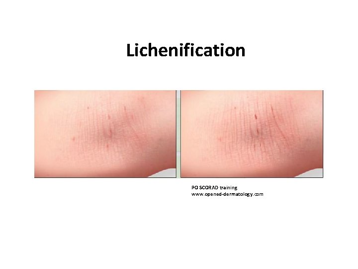 Lichenification PO SCORAD training www. opened-dermatology. com 