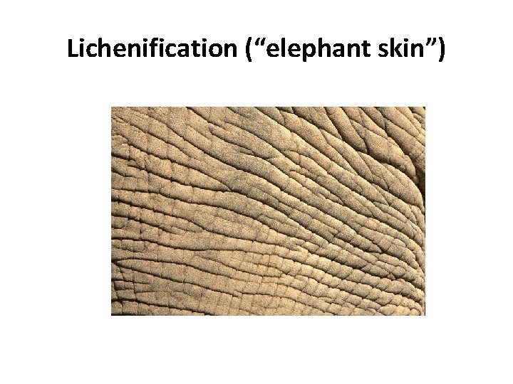 Lichenification (“elephant skin”) 