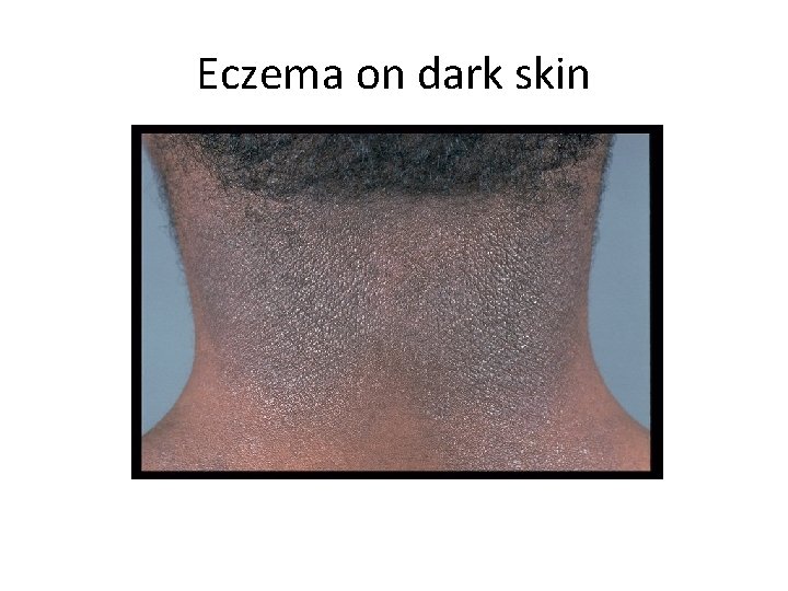 Eczema on dark skin 