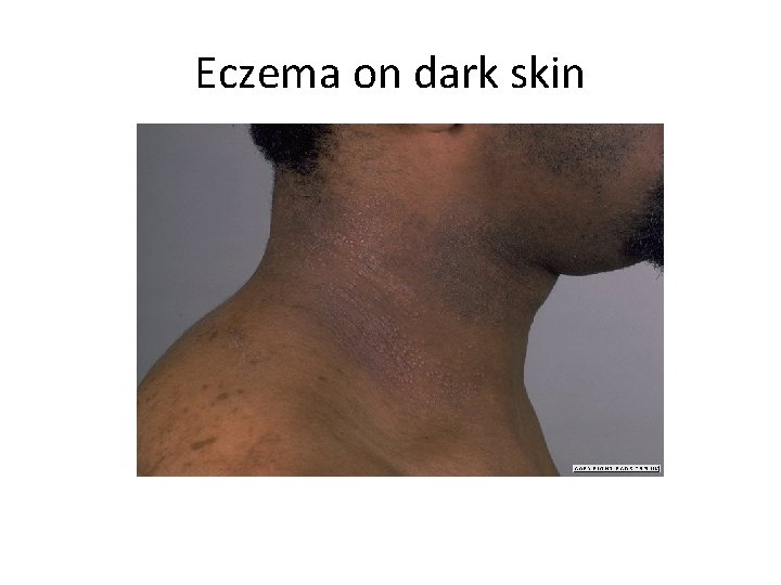 Eczema on dark skin 