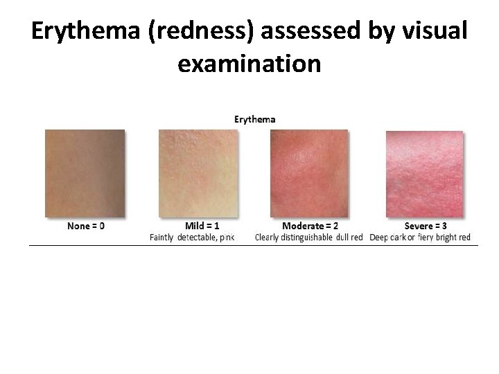 Erythema (redness) assessed by visual examination 