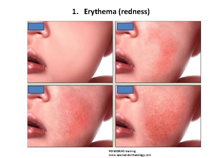 1. Erythema (redness) PO SCORAD training www. opened-dermatology. com 