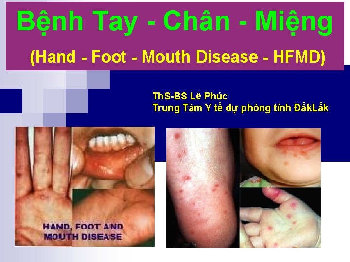 Bệnh Tay - Chân - Miệng (Hand - Foot - Mouth Disease - HFMD)