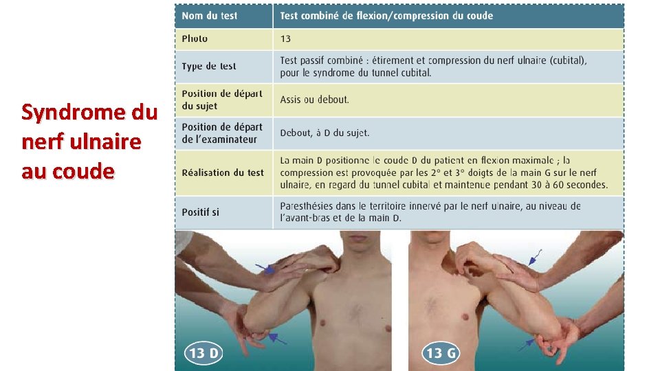 Syndrome du nerf ulnaire au coude 