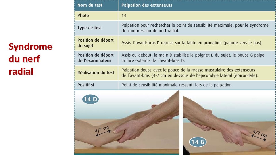 Syndrome du nerf radial 