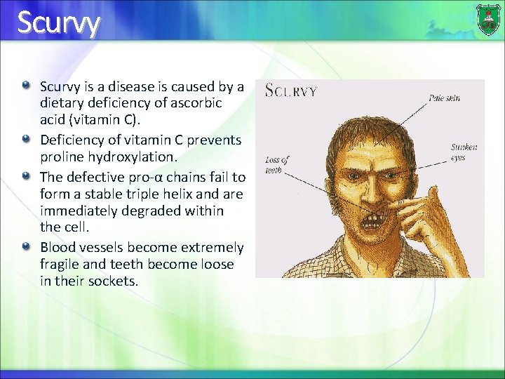 Scurvy is a disease is caused by a dietary deficiency of ascorbic acid (vitamin