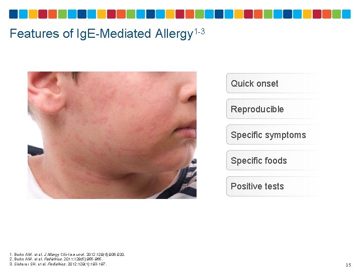 Features of Ig. E-Mediated Allergy 1 -3 Quick onset Reproducible Specific symptoms Specific foods