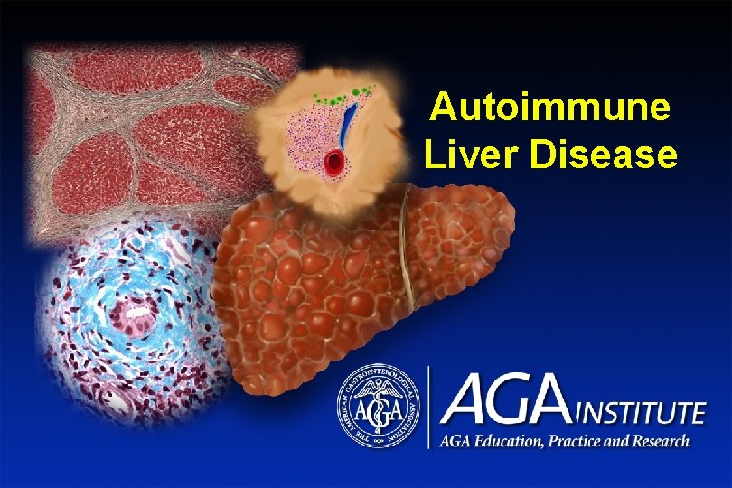 Title Slide Autoimmune Liver Disease 