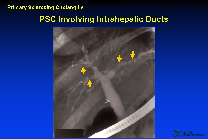 PSC Involving Intrahepatic Ducts Primary Sclerosing Cholangitis PSC Involving Intrahepatic Ducts 