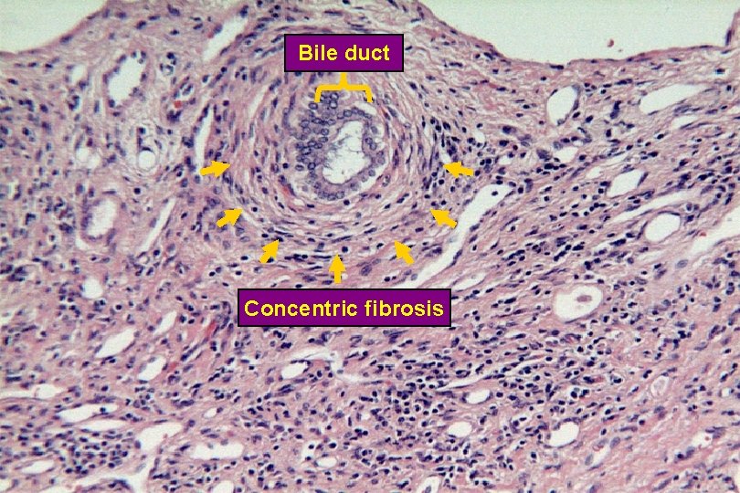 Concentric Fibrosis in PSC Bile duct Concentric fibrosis 