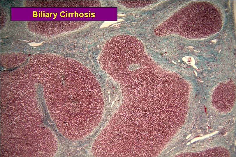 Biliary Cirrhosis 