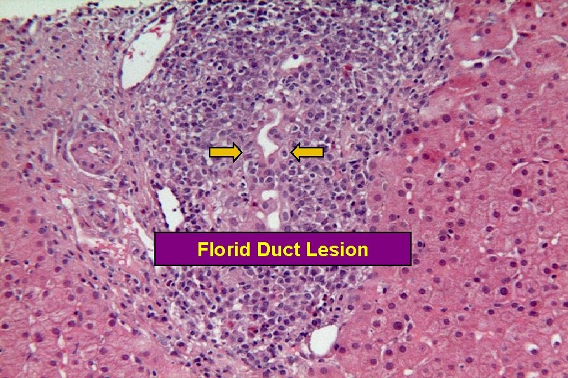 Florid Duct Lesion 