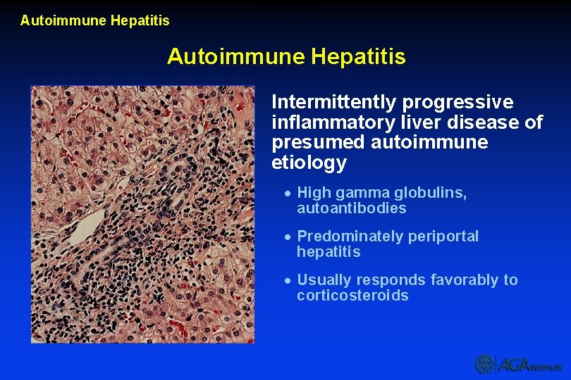 Autoimmune Hepatitis Intermittently progressive inflammatory liver disease of presumed autoimmune etiology · High gamma