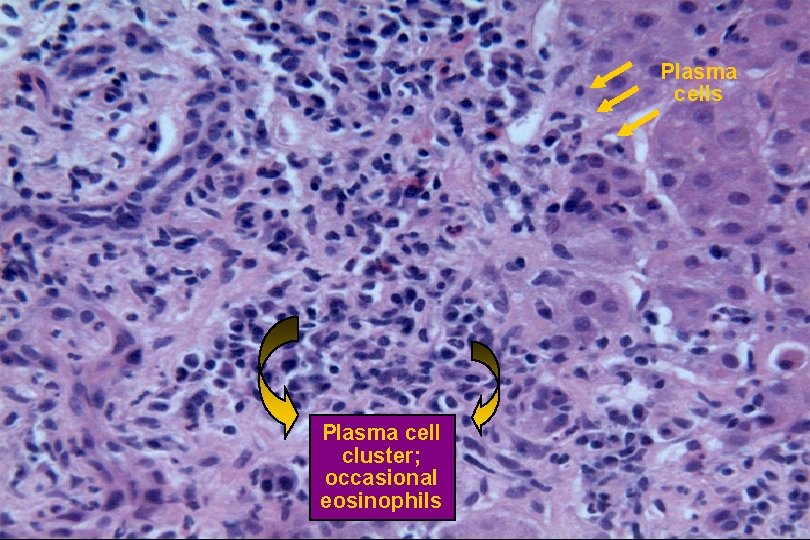 Portal Tract Inflammation Histology Plasma cells Plasma cell cluster; occasional eosinophils 