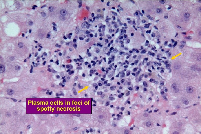 Spotty Necrosis Plasma cells in foci of spotty necrosis 