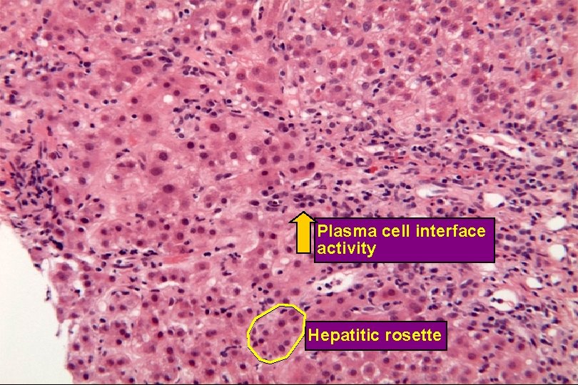 Plasma Cell Interface Activity and Hepatitic Rosettes Plasma cell interface activity Hepatitic rosette 