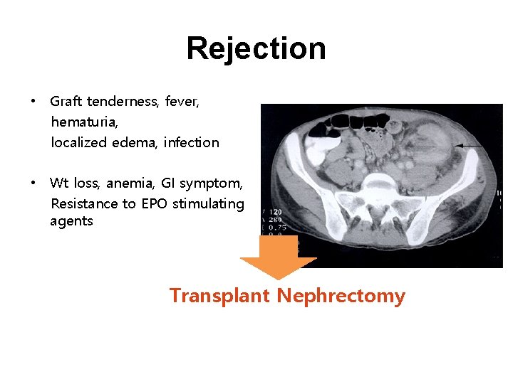 Rejection • Graft tenderness, fever, hematuria, localized edema, infection • Wt loss, anemia, GI
