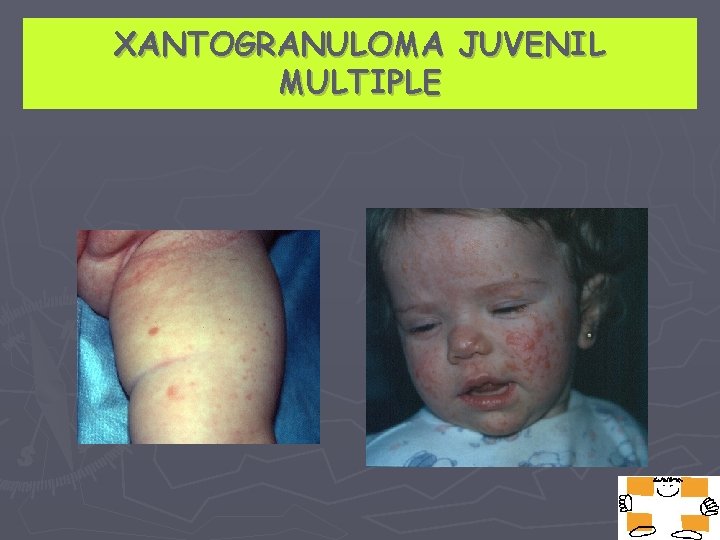 XANTOGRANULOMA JUVENIL MULTIPLE 