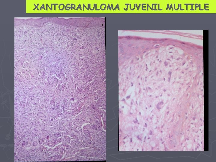 XANTOGRANULOMA JUVENIL MULTIPLE 