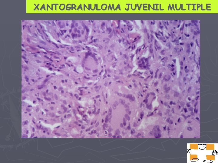 XANTOGRANULOMA JUVENIL MULTIPLE 