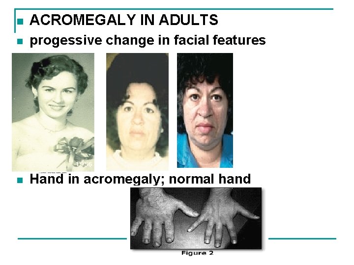 n ACROMEGALY IN ADULTS n progessive change in facial features n Hand in acromegaly;