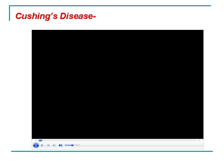 Cushing’s Disease- 