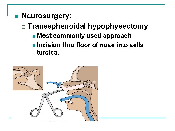 n Neurosurgery: q Transsphenoidal hypophysectomy n Most commonly used approach n Incision thru floor