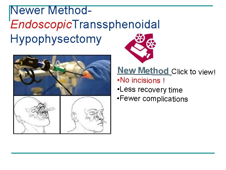 Newer Method. Endoscopic. Transsphenoidal Hypophysectomy New Method Click to view! • No incisions !