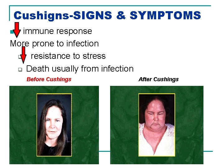 Cushigns-SIGNS & SYMPTOMS immune response More prone to infection q resistance to stress q