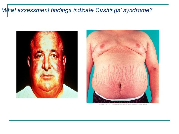 What assessment findings indicate Cushings’ syndrome? 