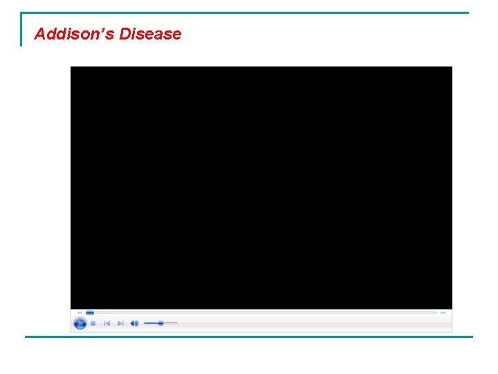 Addison’s Disease 