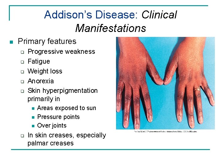 Addison’s Disease: Clinical Manifestations n Primary features q q q Progressive weakness Fatigue Weight