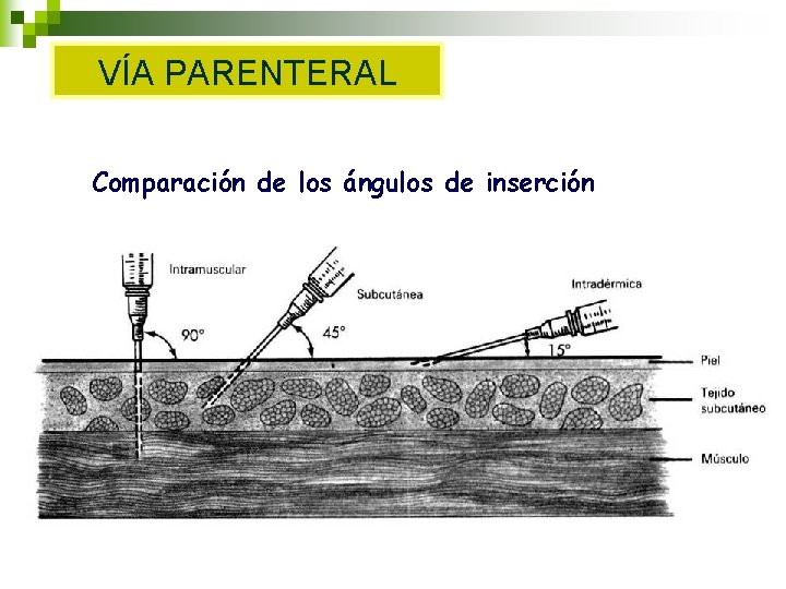 VÍA PARENTERAL Comparación de los ángulos de inserción VÍA PARENTERAL Comparación de los ángulos de inserción