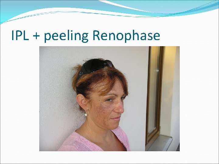 IPL + peeling Renophase 