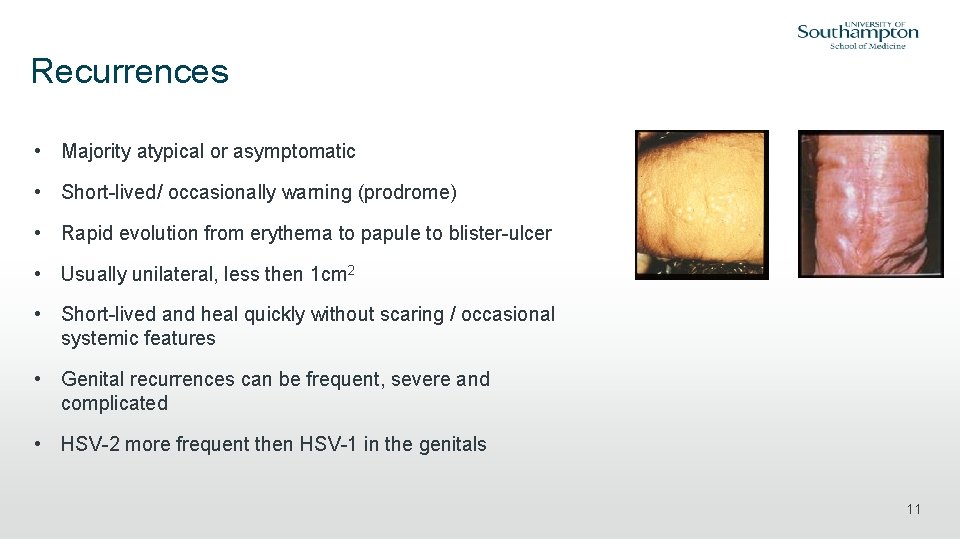 Recurrences • Majority atypical or asymptomatic • Short-lived/ occasionally warning (prodrome) • Rapid evolution