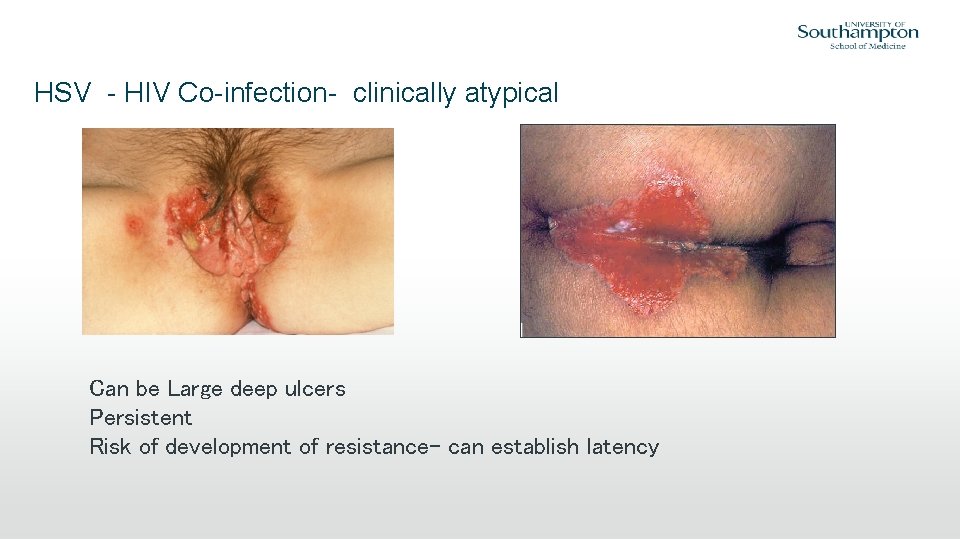 HSV - HIV Co-infection- clinically atypical Can be Large deep ulcers Persistent Risk of