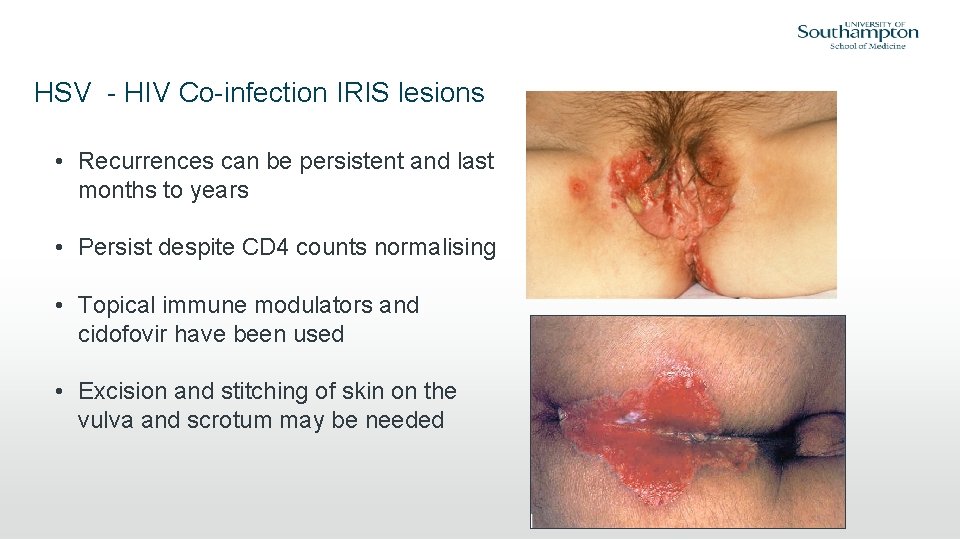 HSV - HIV Co-infection IRIS lesions • Recurrences can be persistent and last months