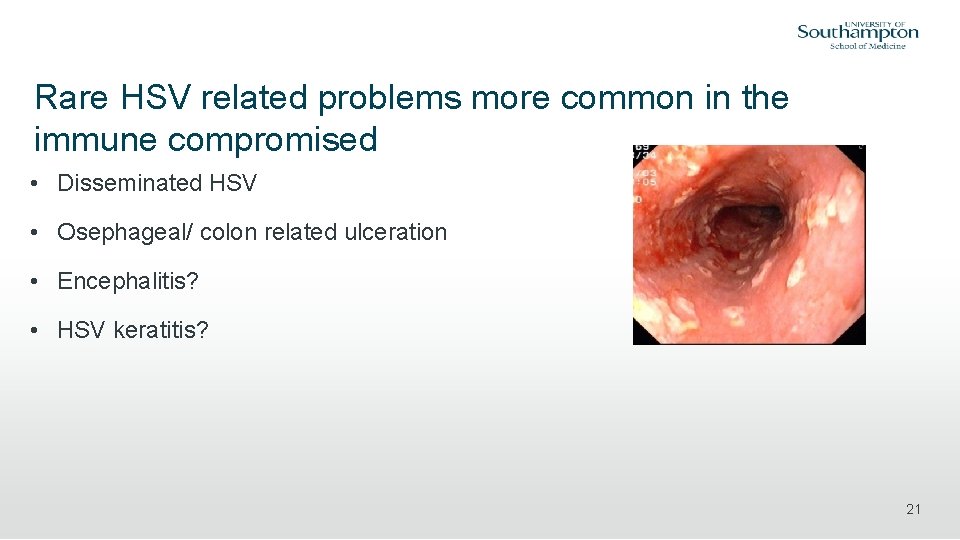 Rare HSV related problems more common in the immune compromised • Disseminated HSV •