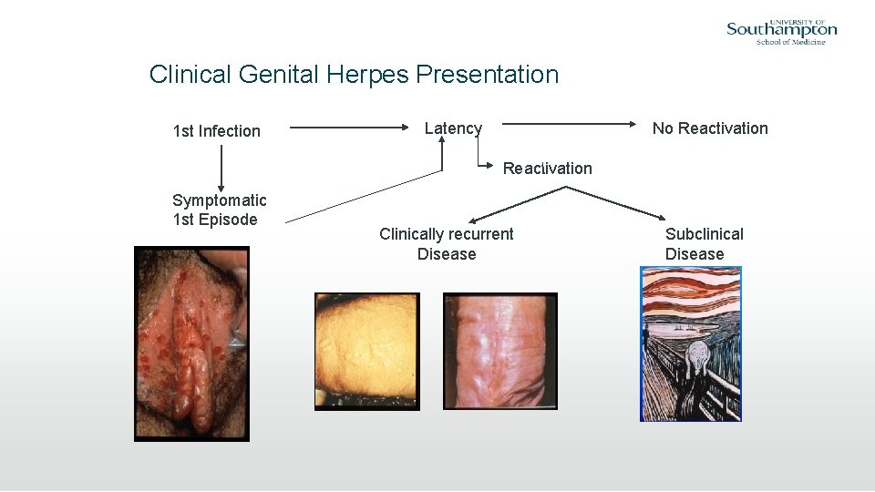 Clinical Genital Herpes Presentation 1 st Infection Latency No Reactivation Symptomatic 1 st Episode