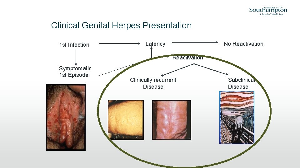 Clinical Genital Herpes Presentation 1 st Infection Latency No Reactivation Symptomatic 1 st Episode