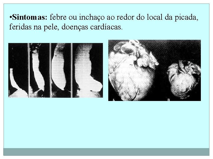  • Sintomas: febre ou inchaço ao redor do local da picada, feridas na