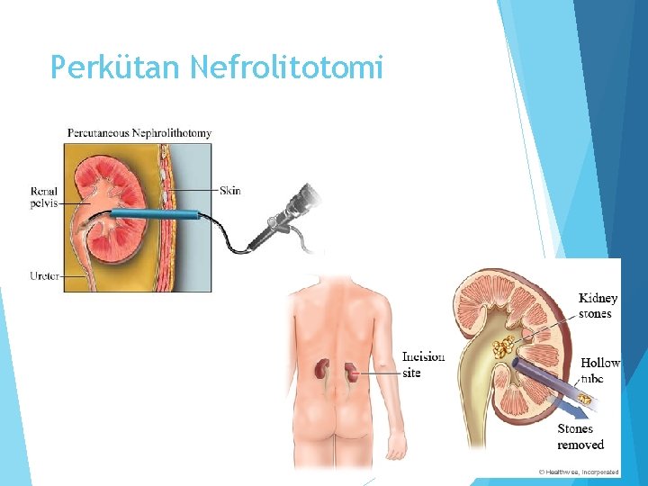 Perkütan Nefrolitotomi 