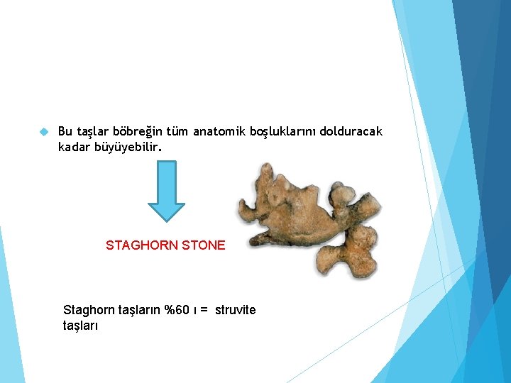  Bu taşlar böbreğin tüm anatomik boşluklarını dolduracak kadar büyüyebilir. STAGHORN STONE Staghorn taşların
