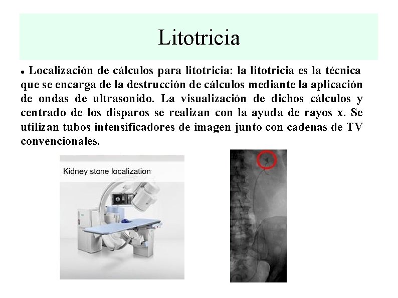 Litotricia Localización de cálculos para litotricia: la litotricia es la técnica que se encarga