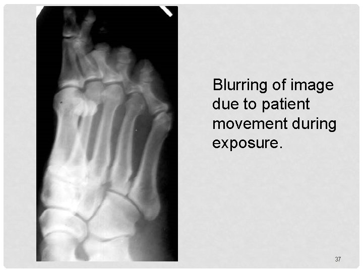 Blurring of image due to patient movement during exposure. 37 