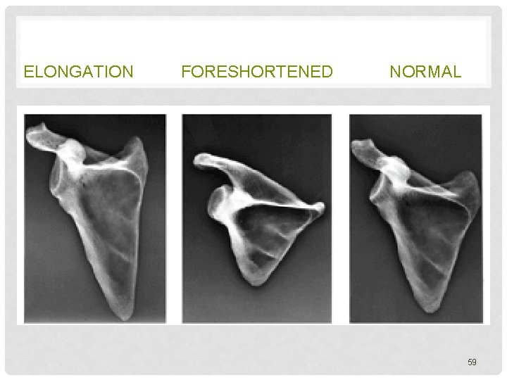 ELONGATION FORESHORTENED NORMAL 59 