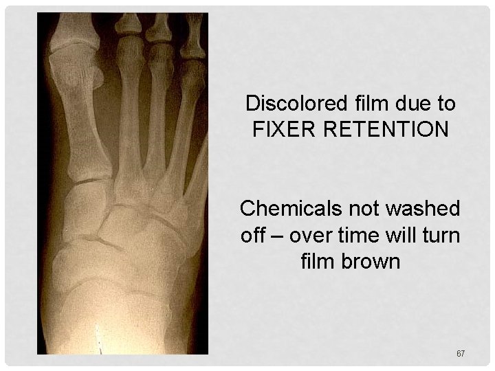 Discolored film due to FIXER RETENTION Chemicals not washed off – over time will