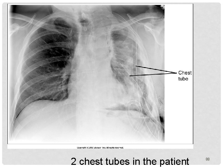 2 chest tubes in the patient 88 