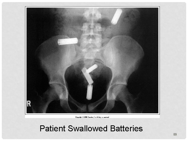 Patient Swallowed Batteries 89 